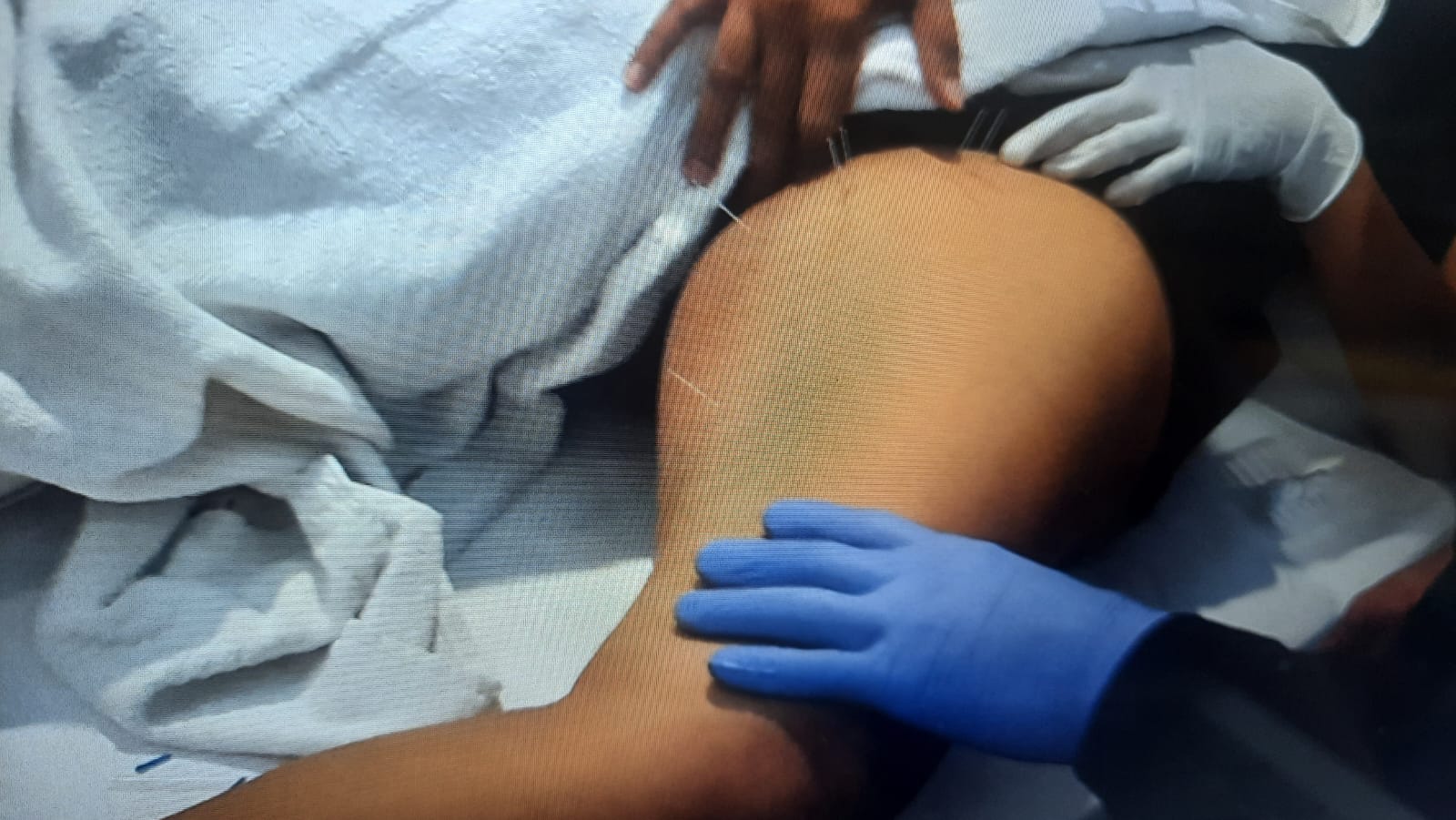 Dry Needling Physiotherapy